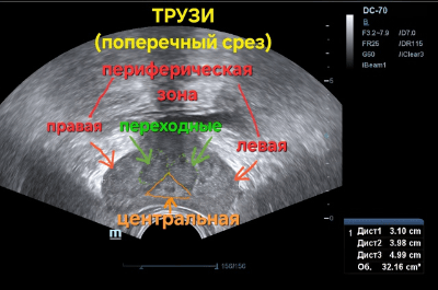 ТРУЗИ, поперечный срез